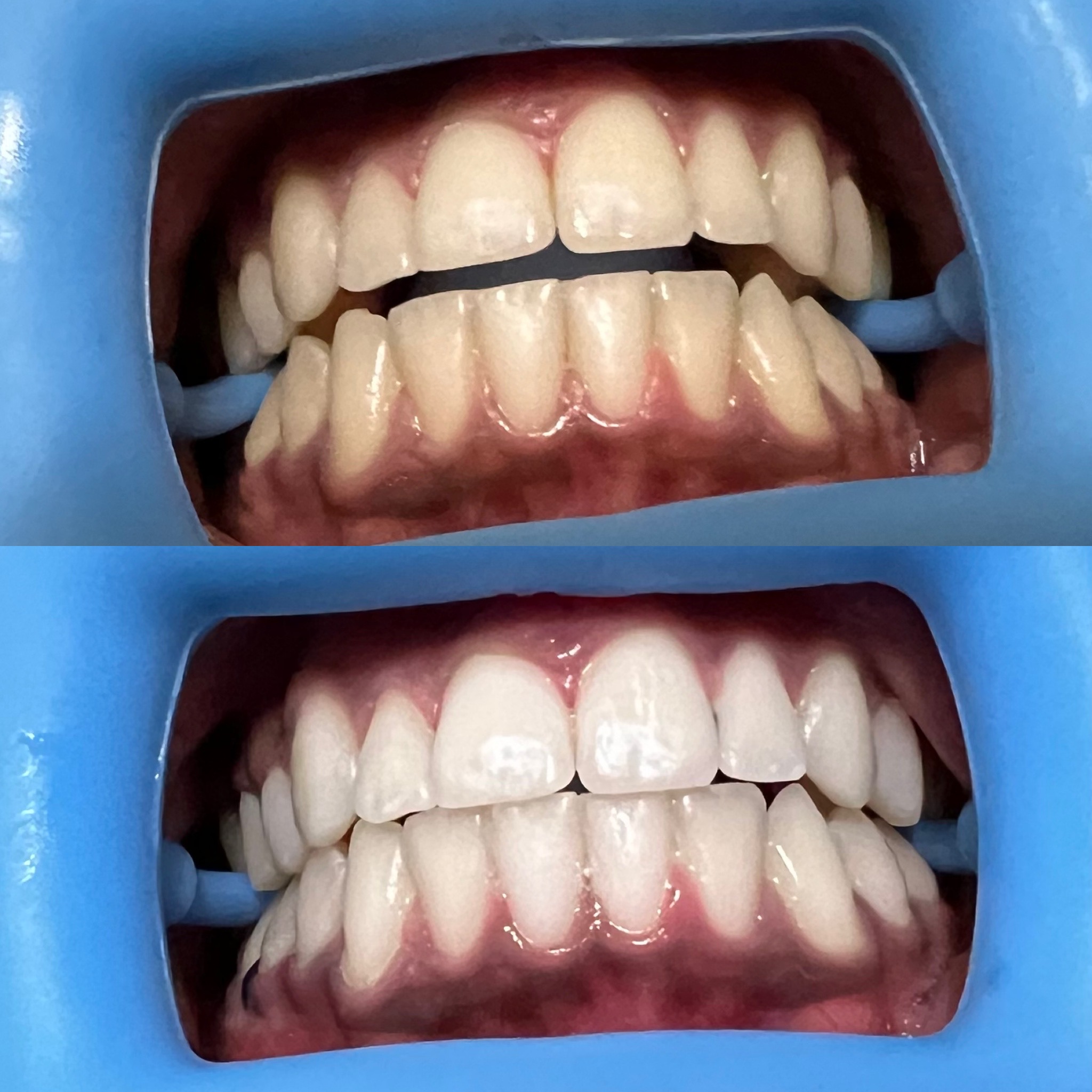 Client smile before whitening (top) and a brighter result after treatment (bottom)