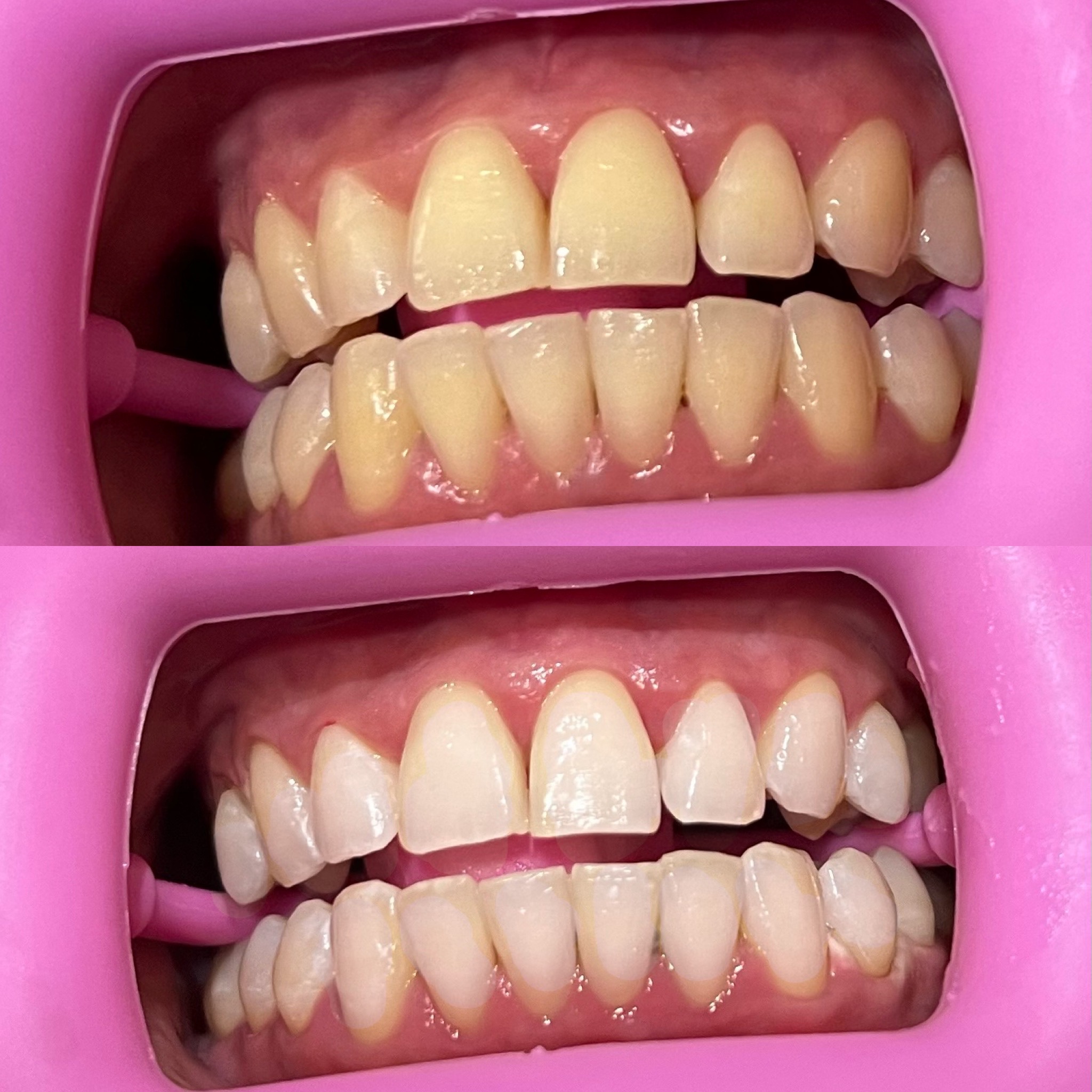 Client teeth before whitening (top) and whiter after treatment (bottom)