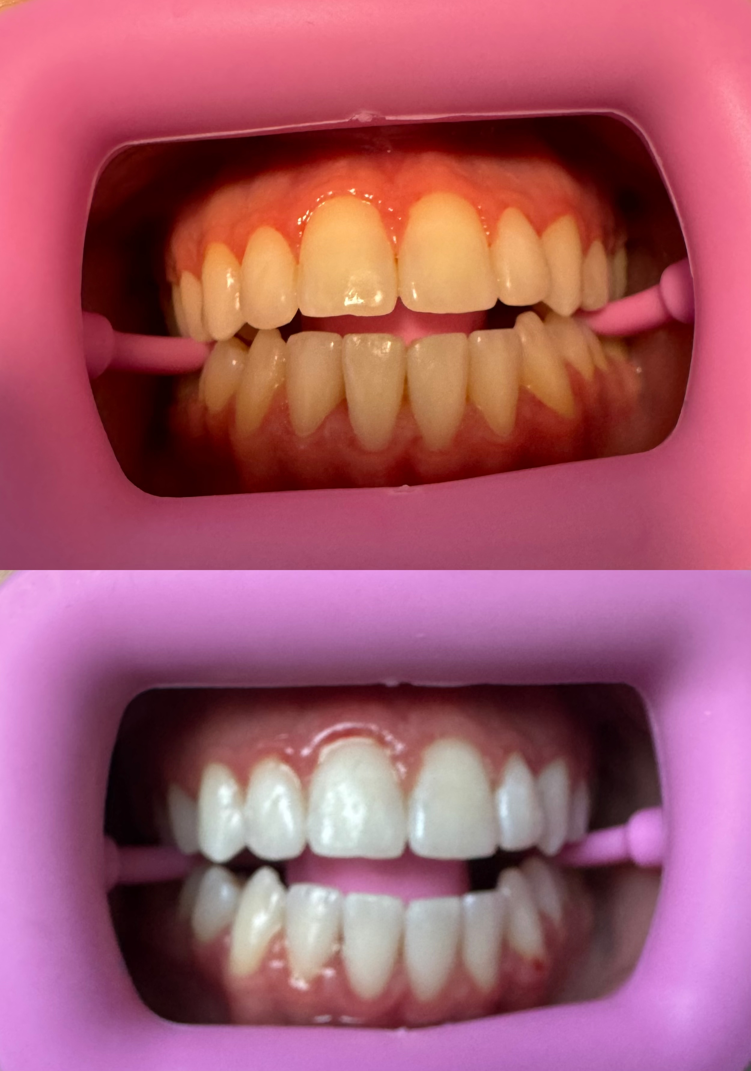 Client smile before and noticeably brighter after whitening treatment